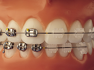 braces-comparison