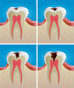 risks-dental-cavities