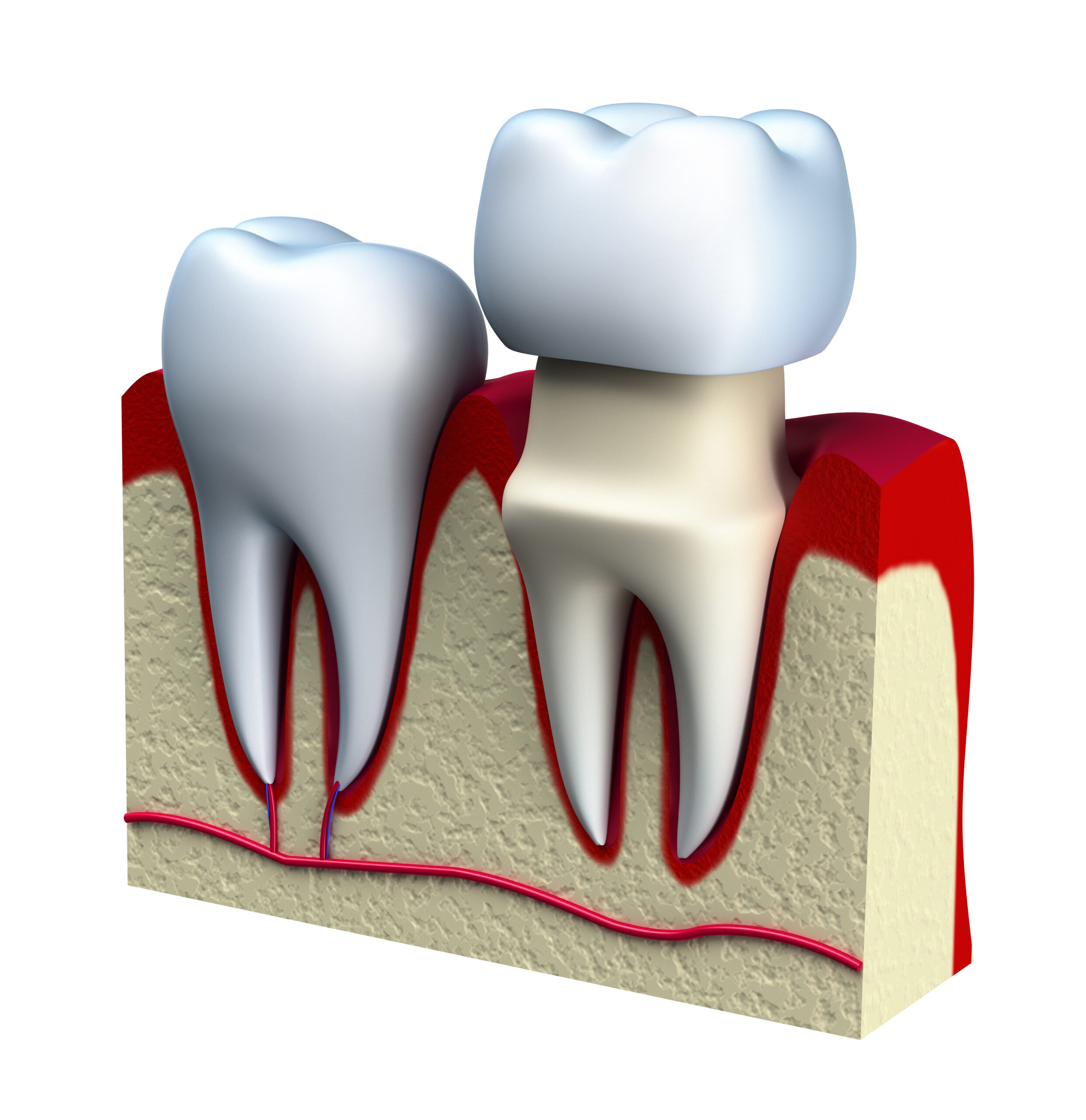 cosmetic-crowns